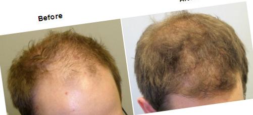 Finasteride Köpa Sverige Finasteride Köpa Sverige