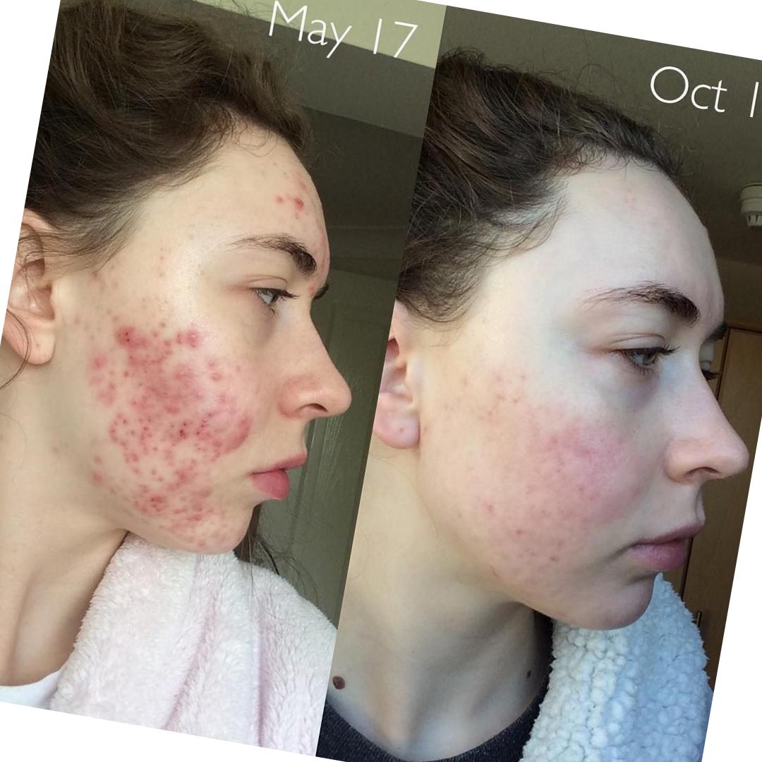 Priset på accutane
