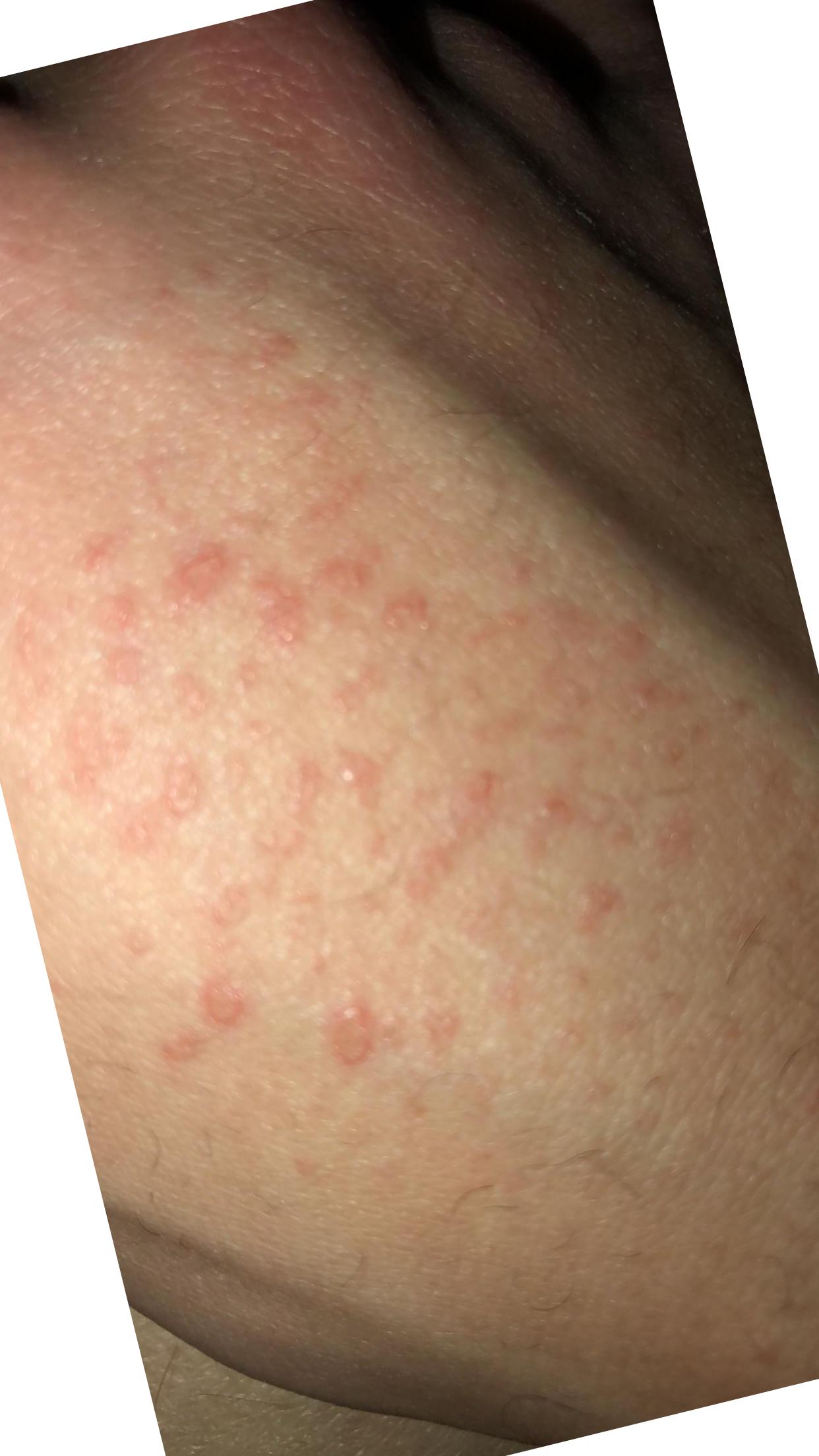 isotretinoin pris
