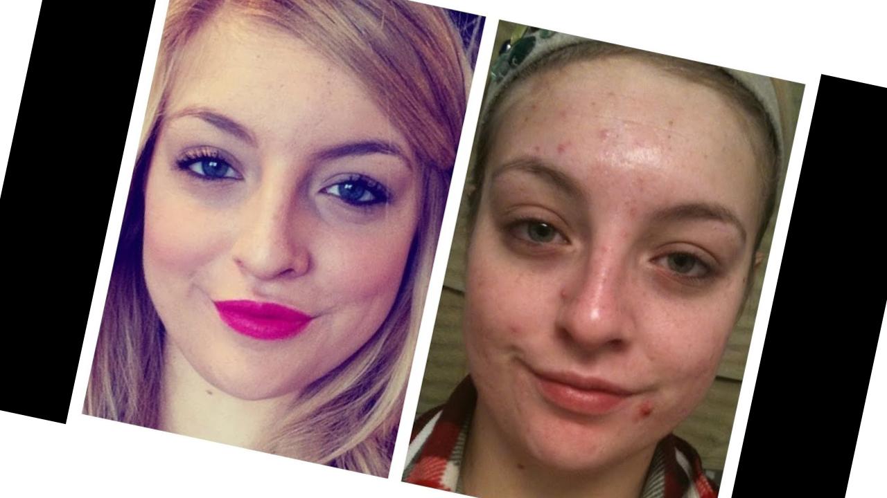 Priset på accutane priset på accutane