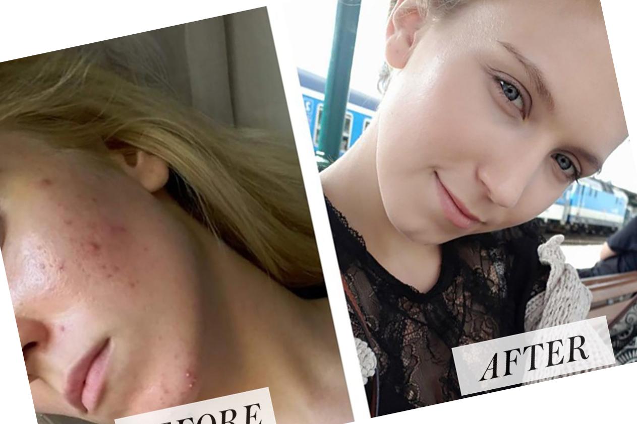 accutane 30mg Accutane 30mg