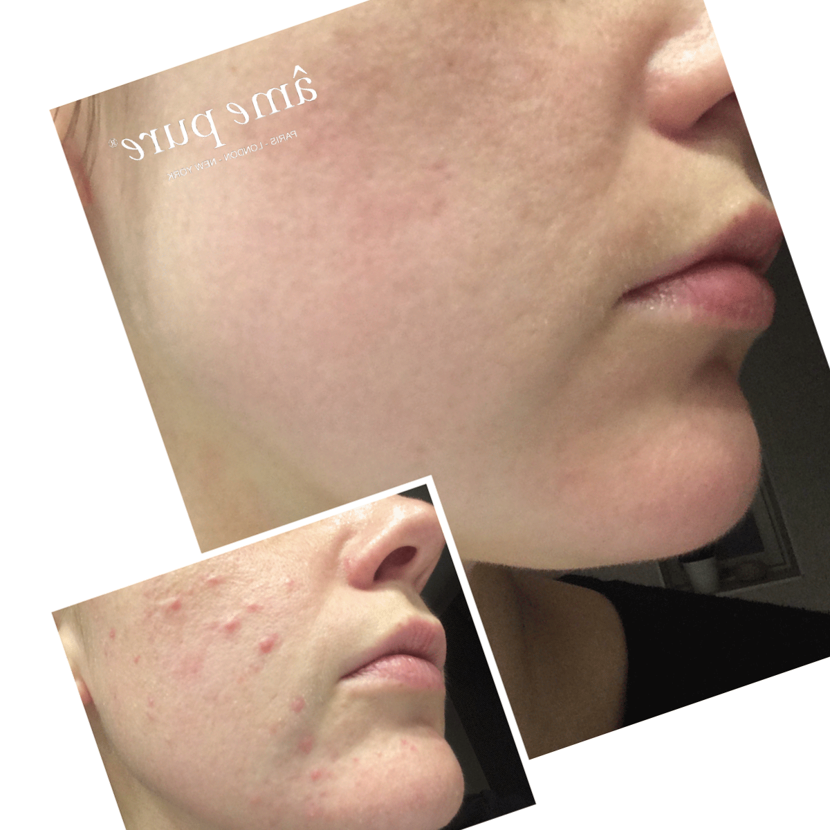 Roaccutane Beställning