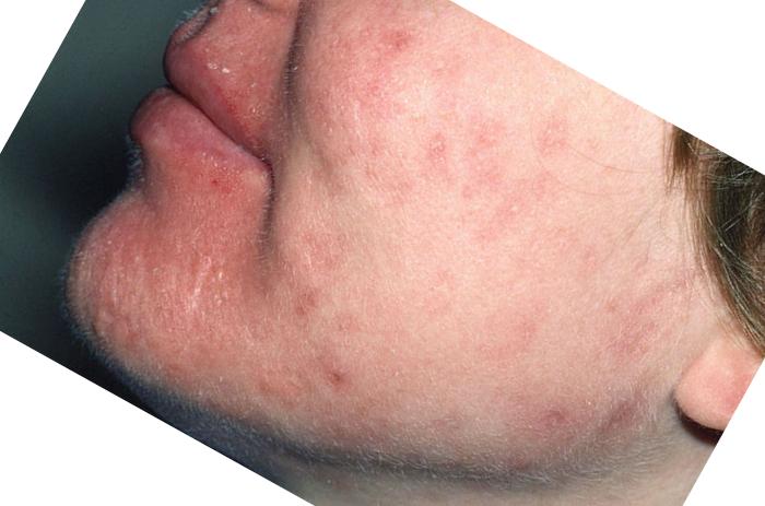 roaccutane tablett