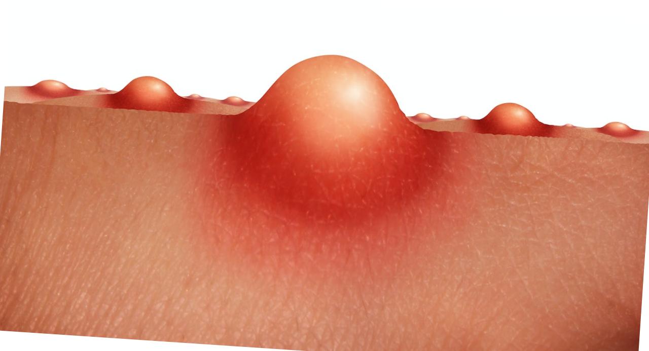 accutane 5mg online