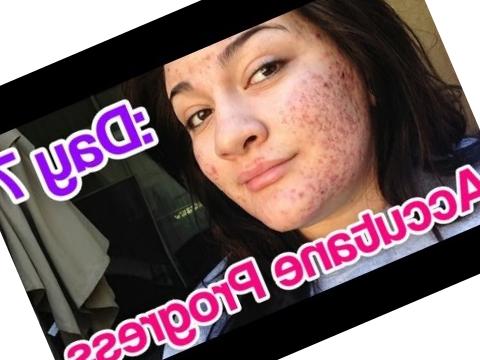 billig accutane billig accutane
