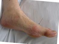Prednisolon tabletter bilder