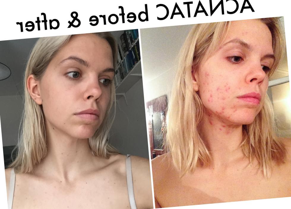 Roaccutan Köp